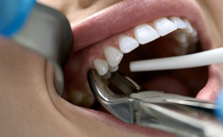 Tooth Extraction के बाद क्या खाना चाहिए और क्या नहीं खाना चाहिए?