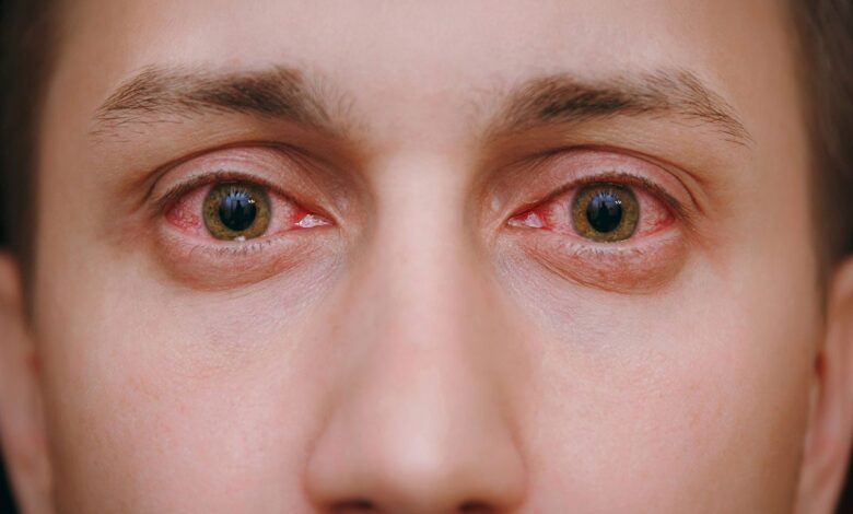 Eye Care: 6 Ways To Avoid Eye Infections During Monsoon