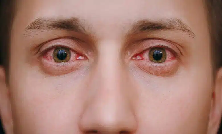 Eye Care: 6 Ways To Avoid Eye Infections During Monsoon