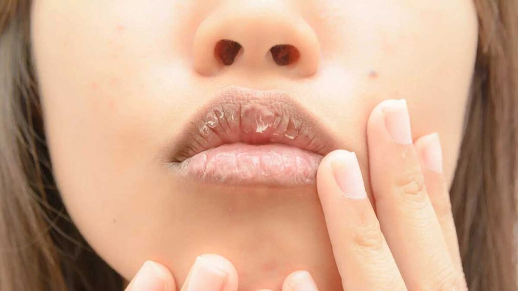 Dry Mouth: What is it?