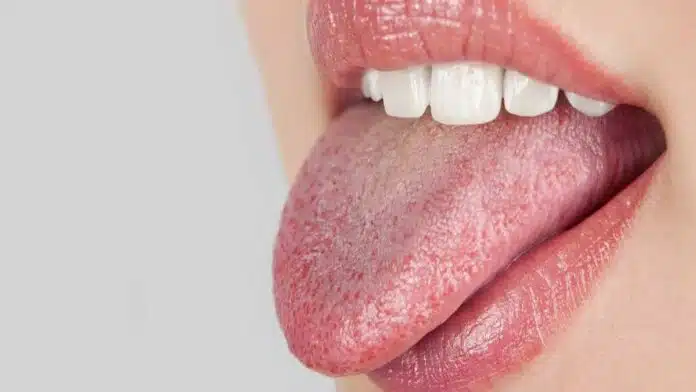 Dry Mouth: What is it?