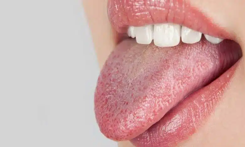 Dry Mouth: What is it?