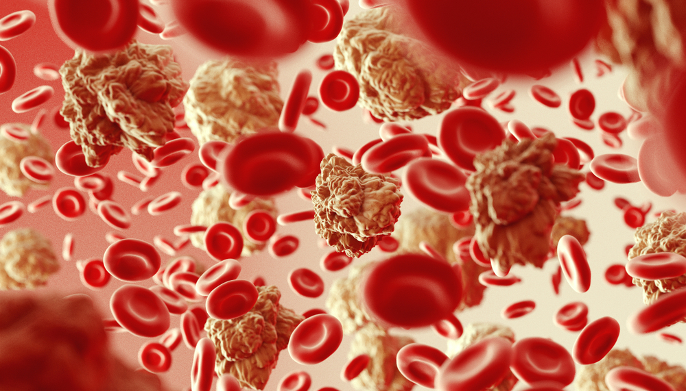 Blood Cancer Symptoms Causes and Treatment 1