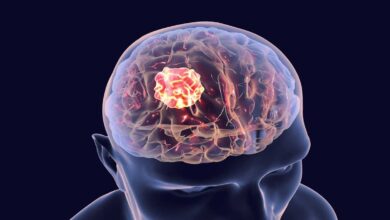 Brain Cancer: Know the symptoms and remedies