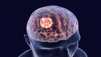 Brain Cancer: Know the symptoms and remedies