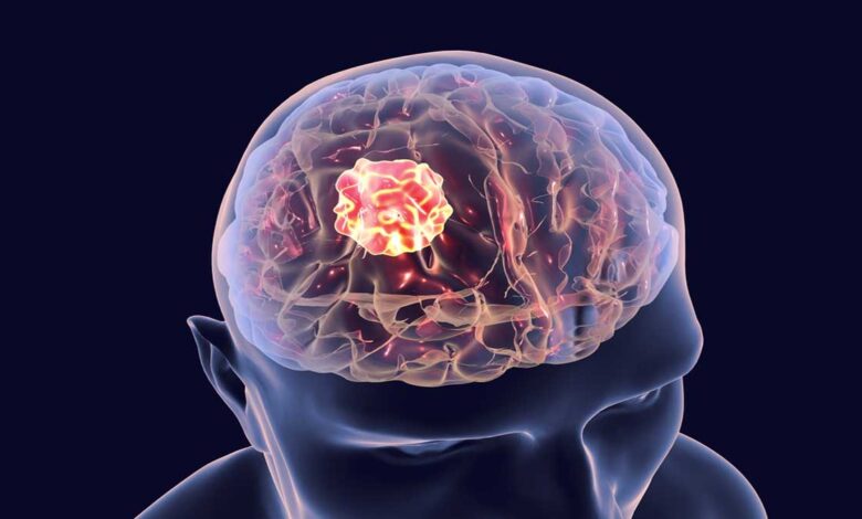 Brain Cancer: Know the symptoms and remedies