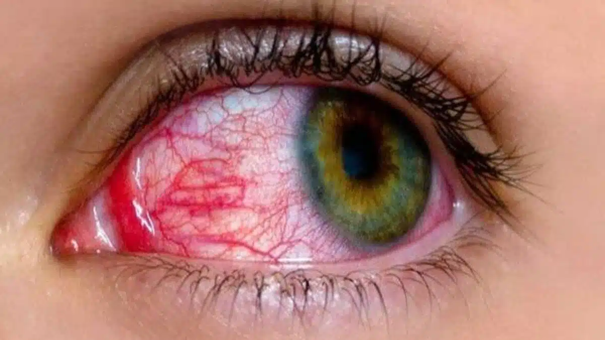 Eye Flu Symptoms, Causes and Home Remedies