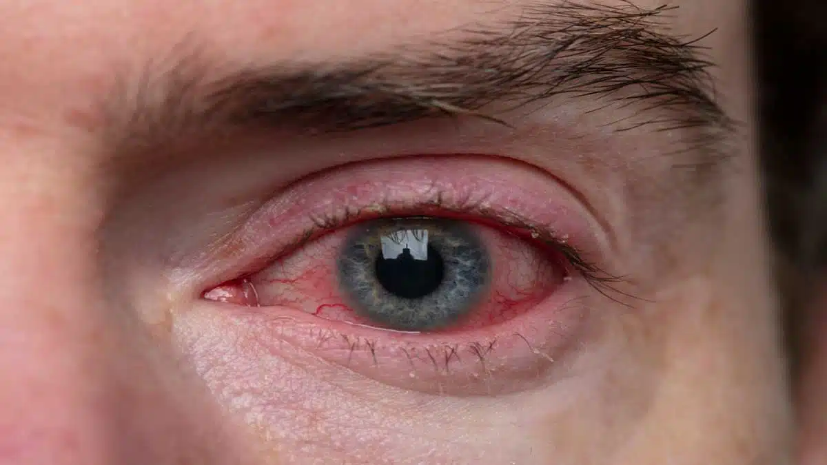 Eye Problems Causes and Treatment 2