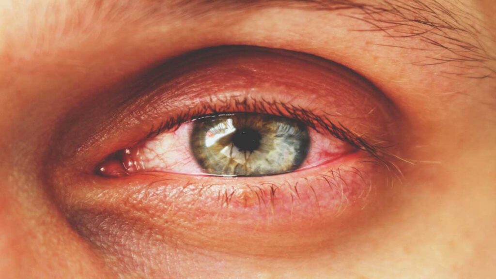 General knowledge of eye diseases 2