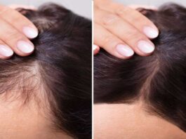 Grandmother's remedies for hair fall- The simplest cure for baldness