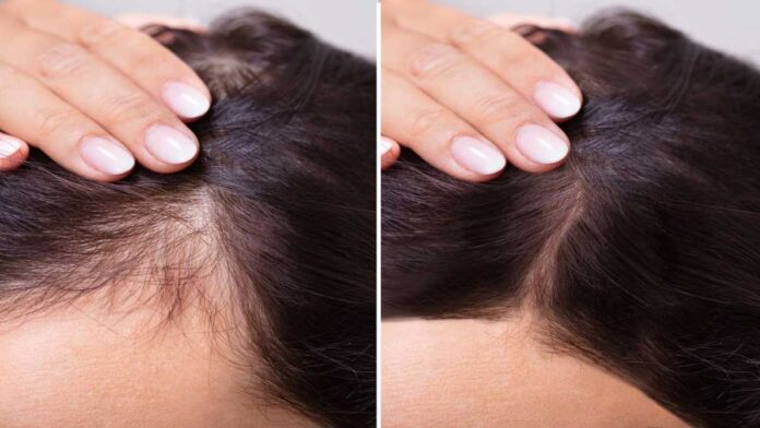 Grandmother's remedies for hair fall- The simplest cure for baldness