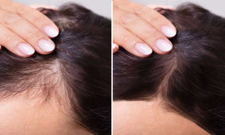 Grandmother's remedies for hair fall- The simplest cure for baldness