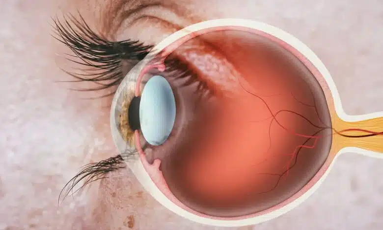 Home remedies for eye problems
