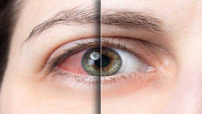Symptoms and remedies of eye diseases