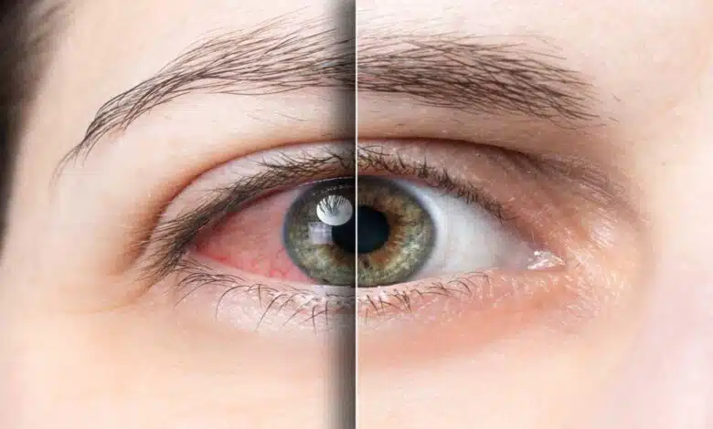 Symptoms and remedies of eye diseases