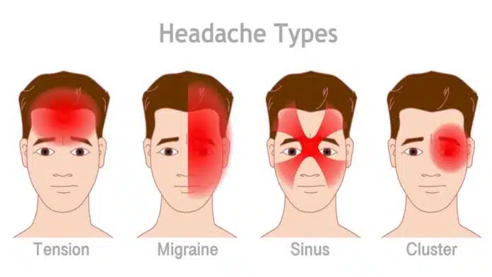 Understanding and Treating Headaches The Detailed Guide