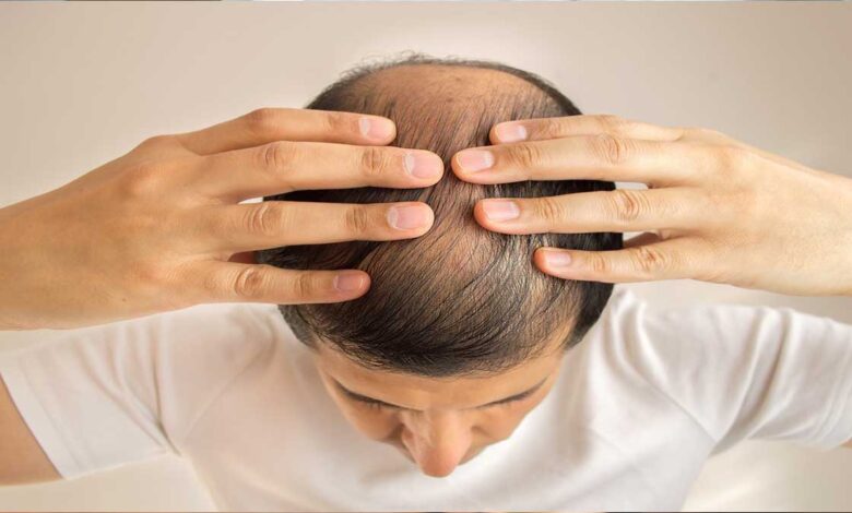 Hair fall- Here is the best hairfall solution
