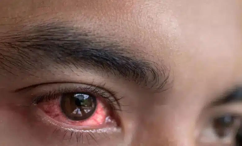 What should we eat to keep our eyes healthy