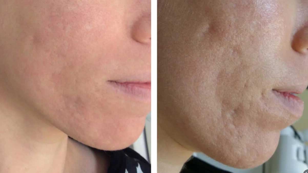 Information about Laser Treatment for Acne Scars