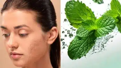 5 Ways to Use Mint Leaves to Reduce Acne Scars