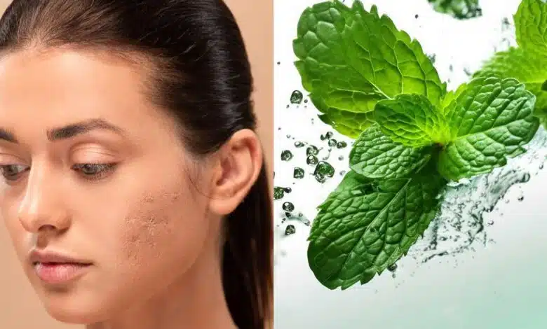 5 Ways to Use Mint Leaves to Reduce Acne Scars