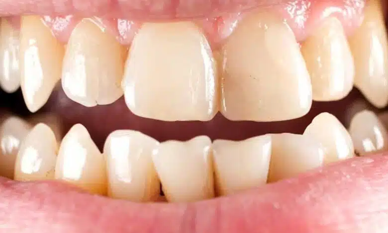 7 Natural Home Remedies to Get Rid of Tartar