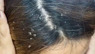 8 easy home remedies to get rid of hair dandruff