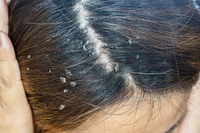 8 easy home remedies to get rid of hair dandruff