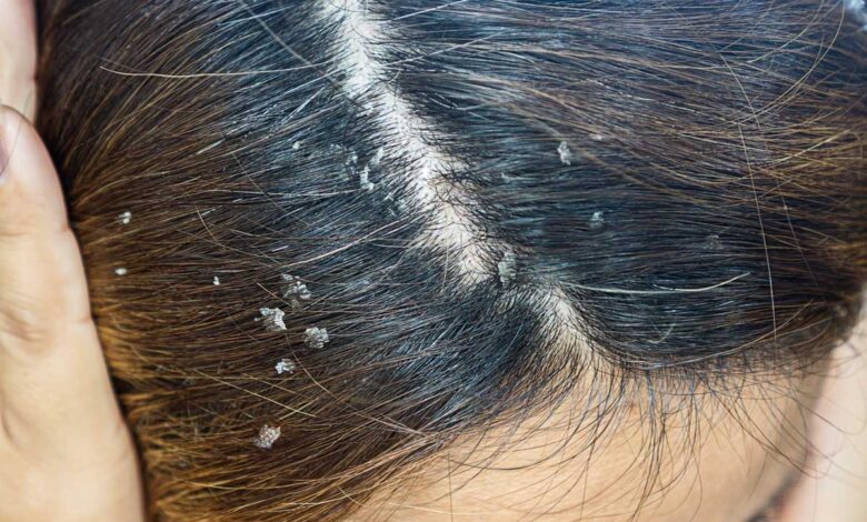 8 easy home remedies to get rid of hair dandruff