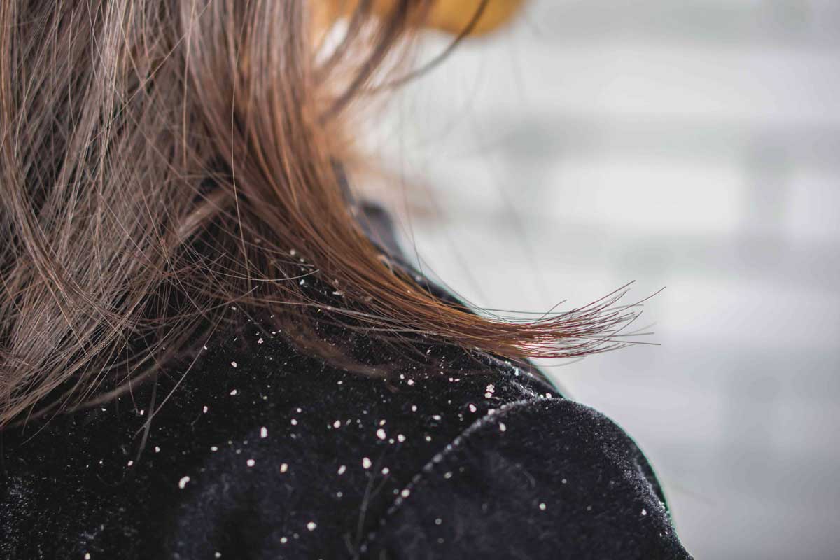 8 easy home remedies to get rid of dandruff