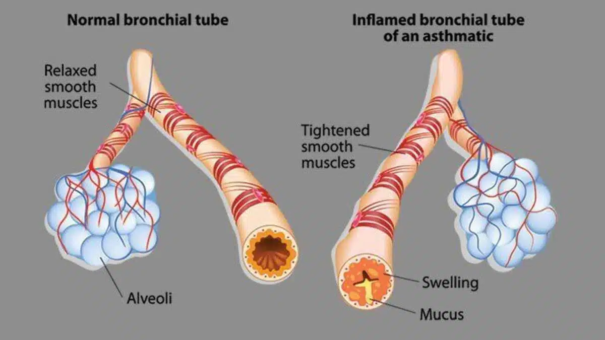 Asthma is a serious disorder