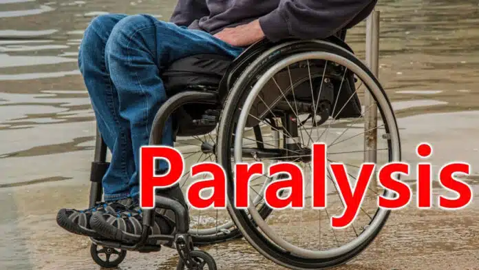 Can paralysis be cured by exercise