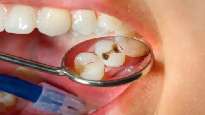 Can rotten teeth be fixed