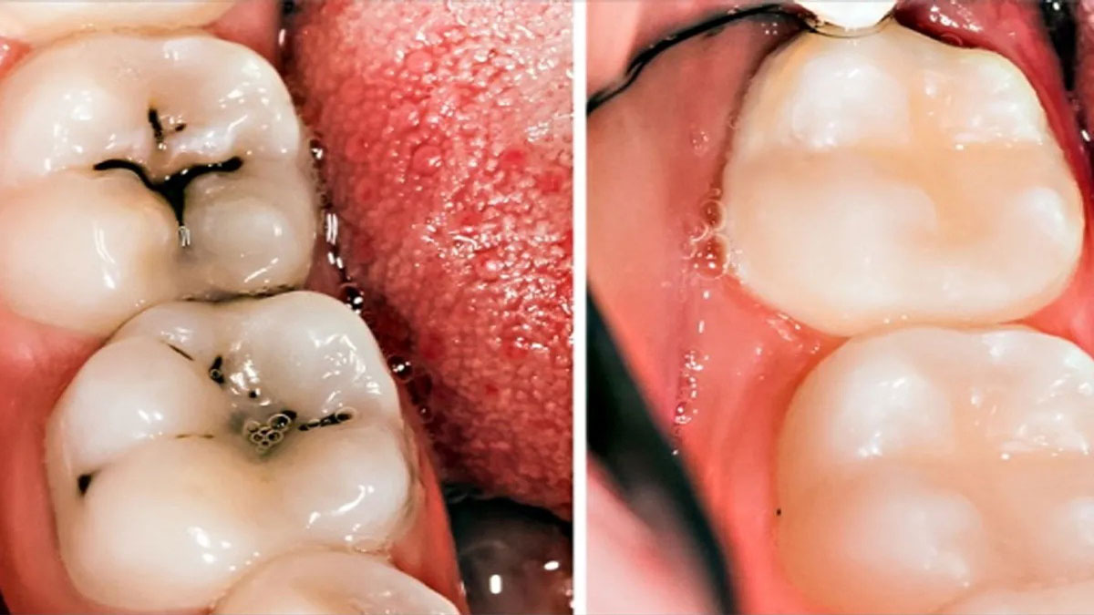 Can rotten teeth be fixed