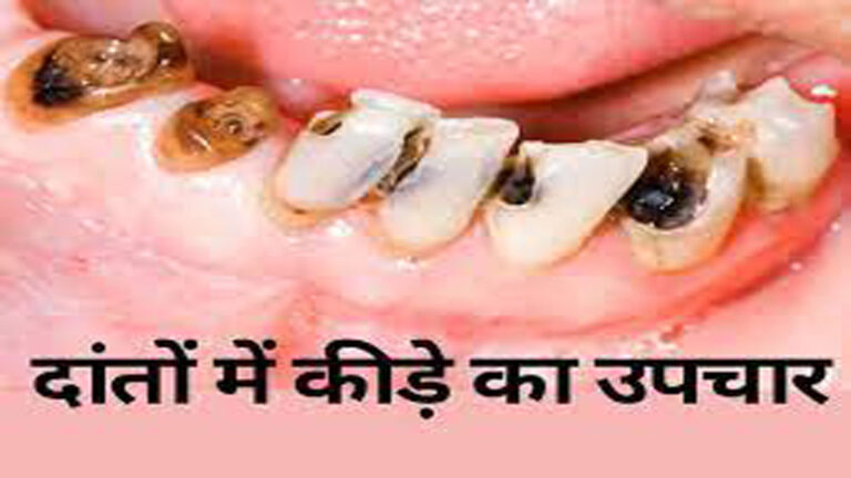 Teeth में लगे कीड़े को कैसे खत्म करें?