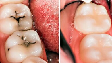 How to relieve teethache with garlic