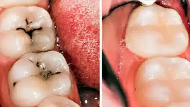 How to relieve teethache with garlic