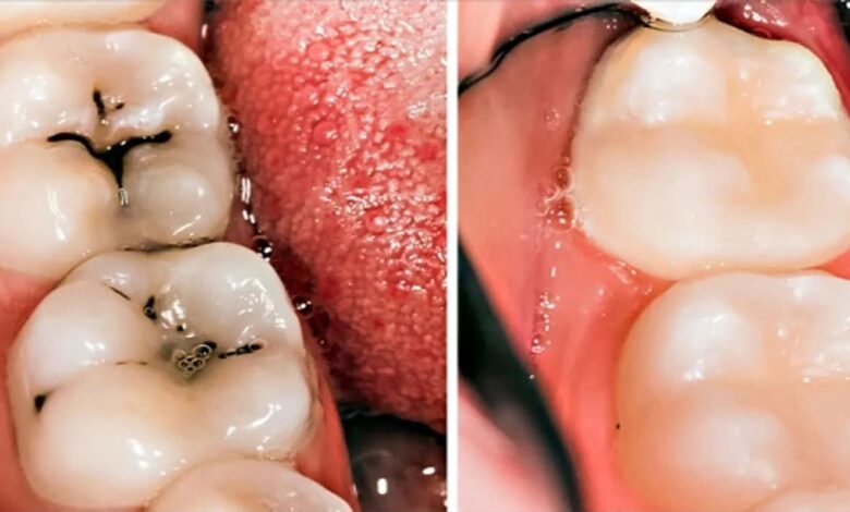 How to relieve teethache with garlic