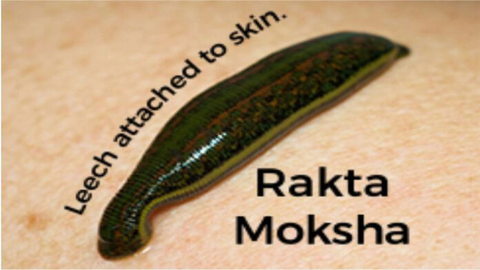 Raktamokshana (Leech Therapy) Panchakarma treatment for blood purification