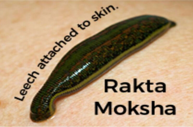 Raktamokshana (Leech Therapy) Panchakarma treatment for blood purification