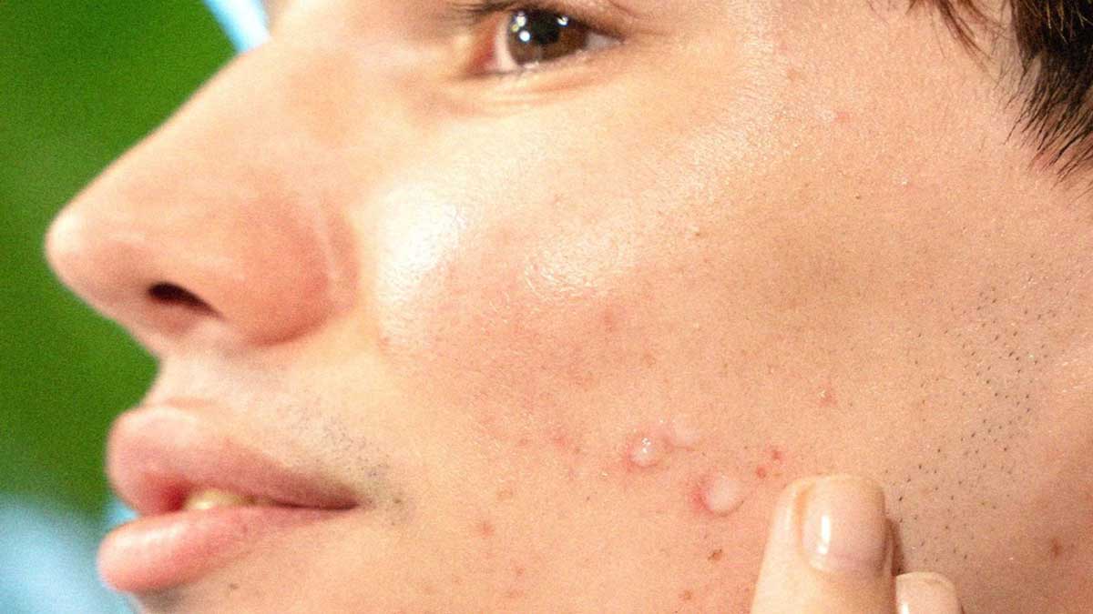 What is Acne Scar Know its treatment