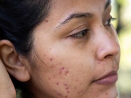 What is Acne Scar Know its treatment