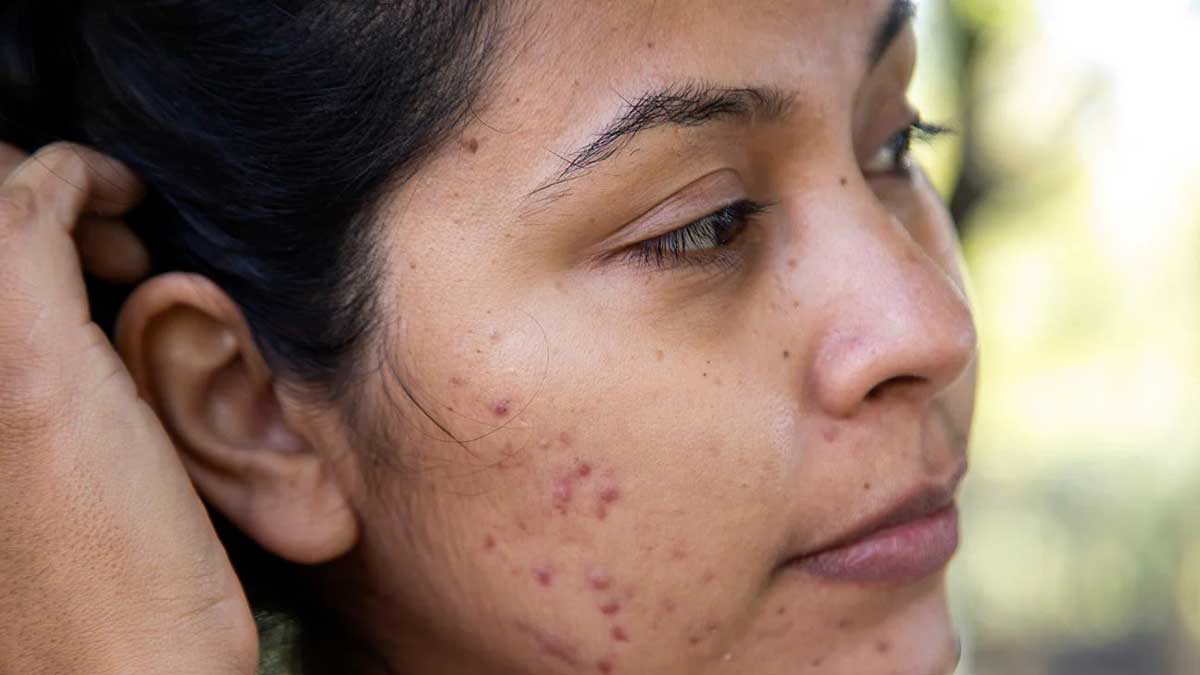 What is Acne Scar Know its treatment