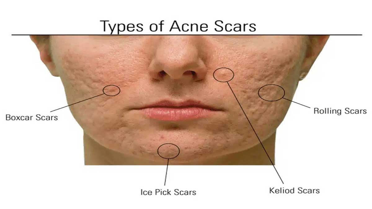 What is Acne Scar Know its treatment