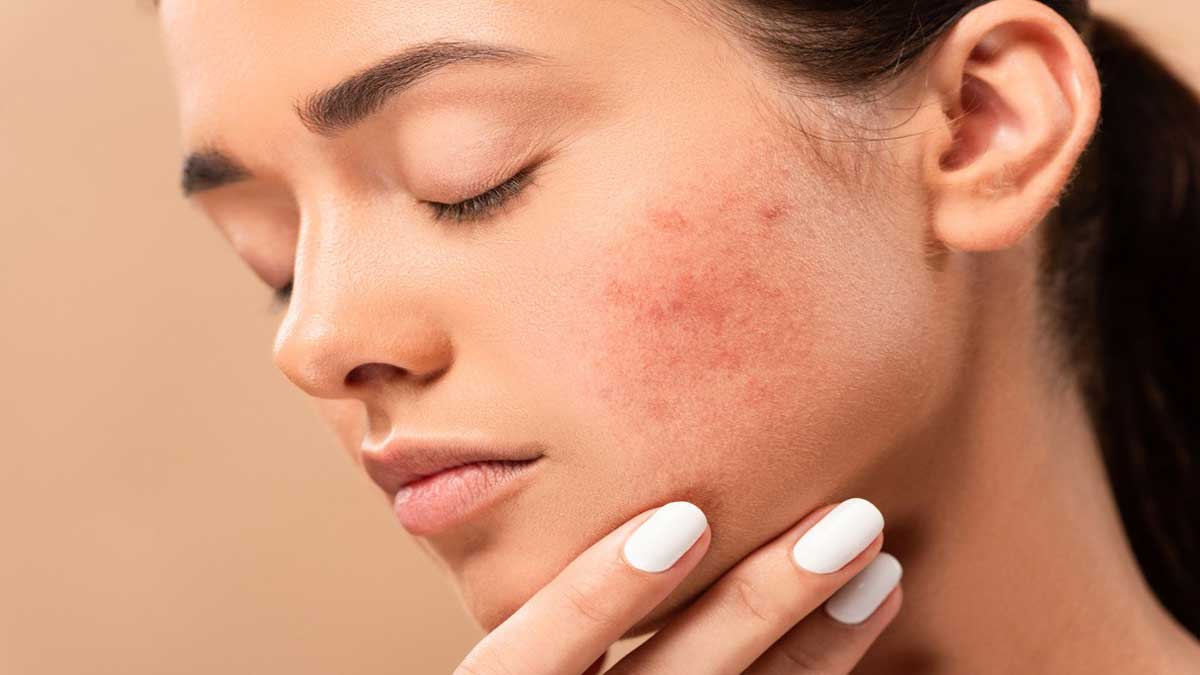 What is Acne Scar Know its treatment