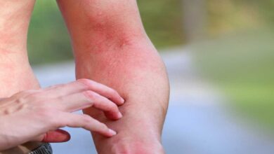 8 Natural Remedies for Allergies.