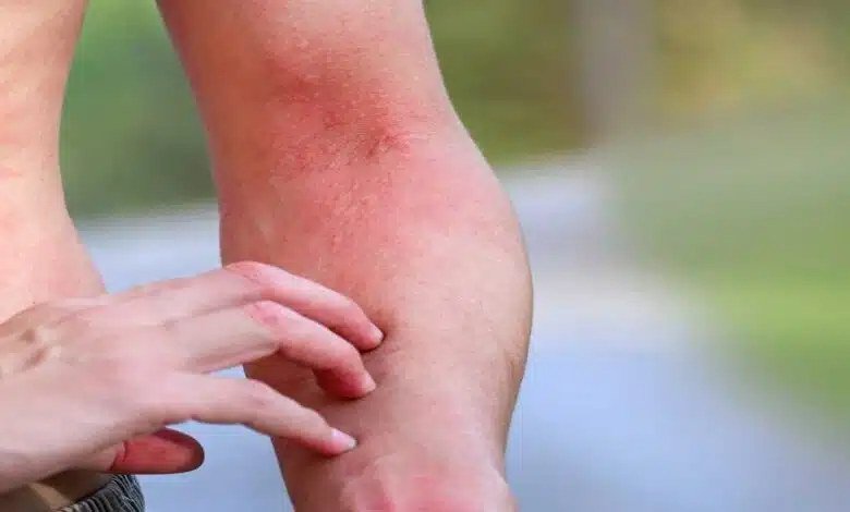 8 Natural Remedies for Allergies.