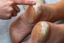 Cracked Heels These four reasons are the reason behind cracked heels and not due to cold, do these things to cure them overnight