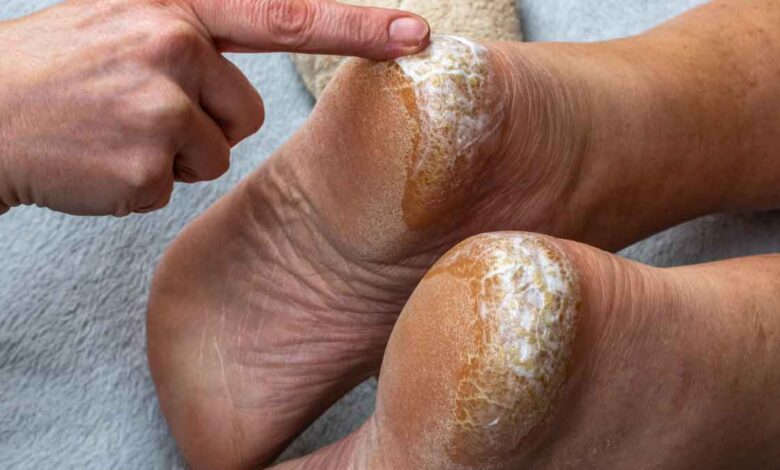 Cracked Heels These four reasons are the reason behind cracked heels and not due to cold, do these things to cure them overnight