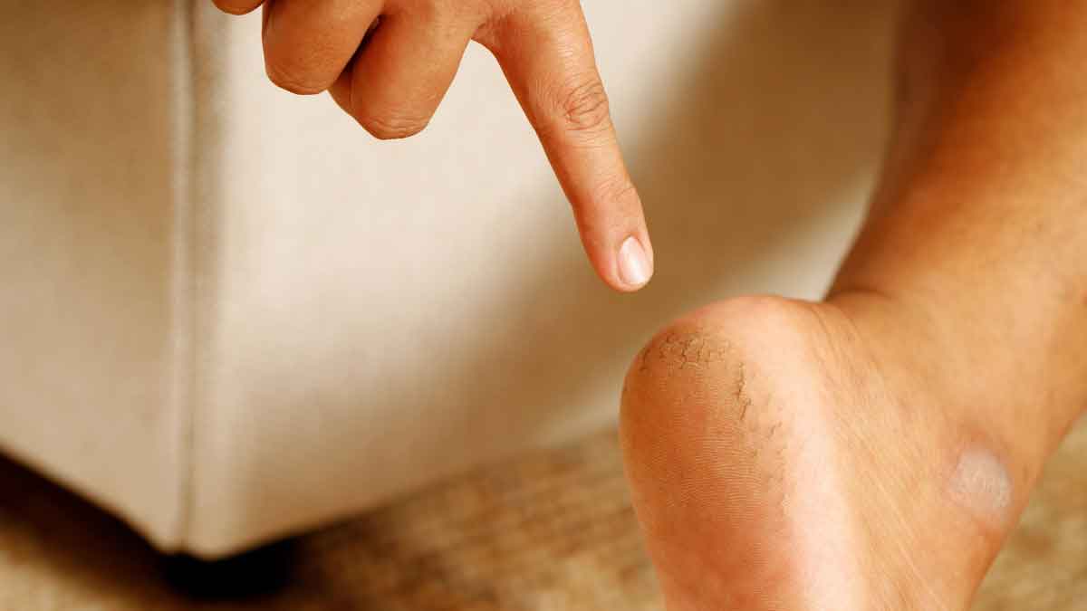 Cracked Heels These four reasons are the reason behind cracked heels and not due to cold, do these things to cure them overnight